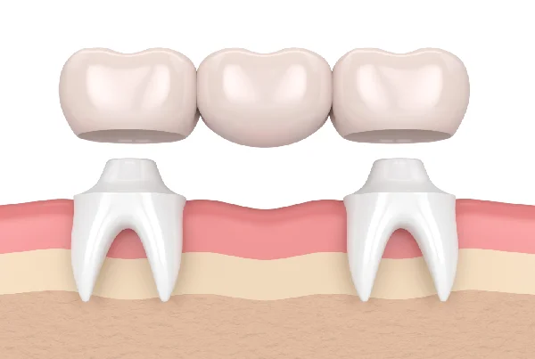 Fix Crown and Bridge